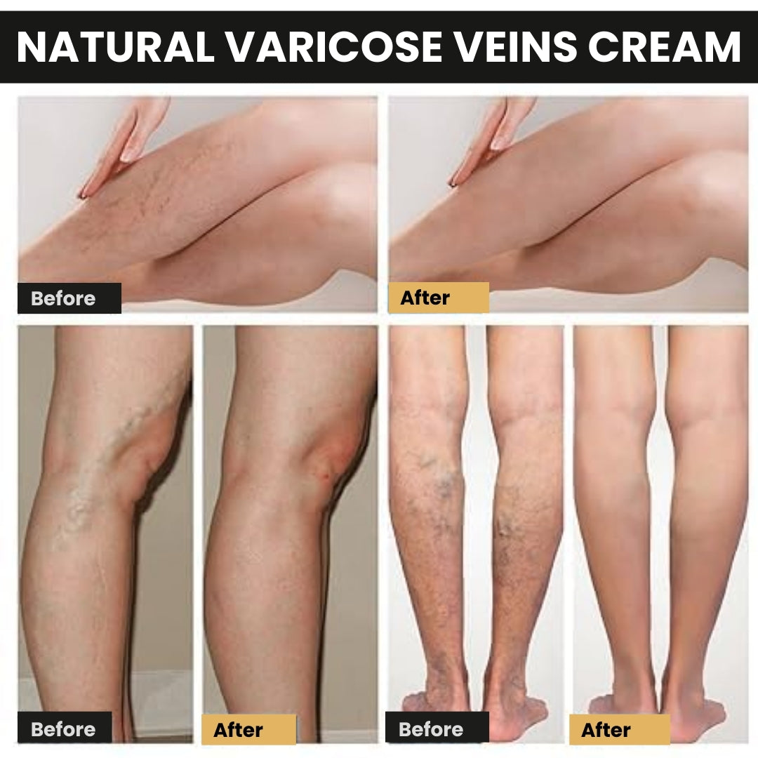 Varicose Veins Patches – Natural Relief for Swelling, Pain & Circulation Support